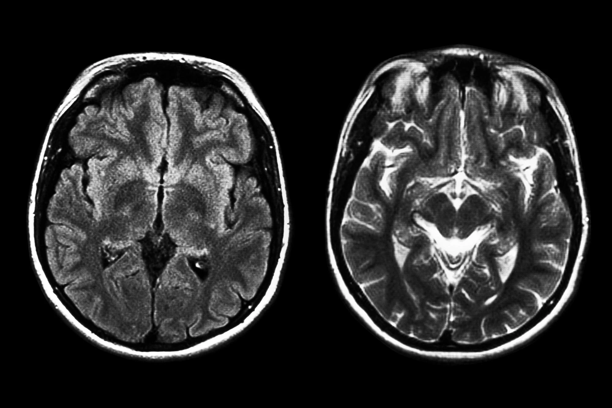 MRI חושף שינויים מוחיים מפתיעים בחולי מגל